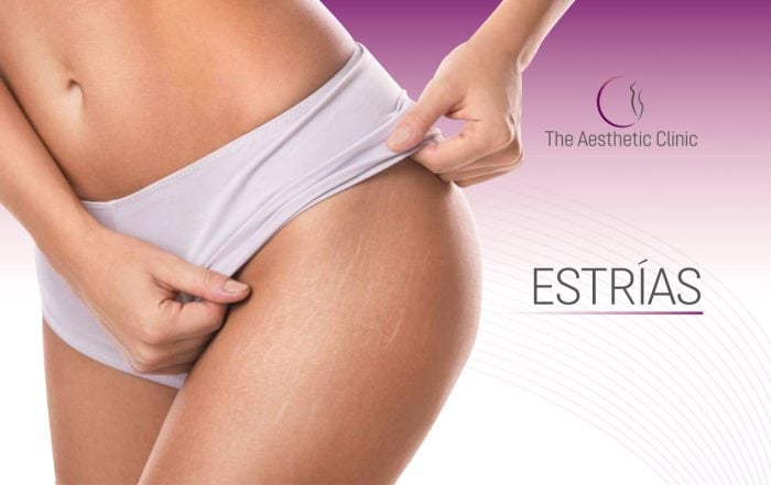 blog Recuperadoestrias 700x441 - Can I Lift my Buttocks with a Safe Treatment?