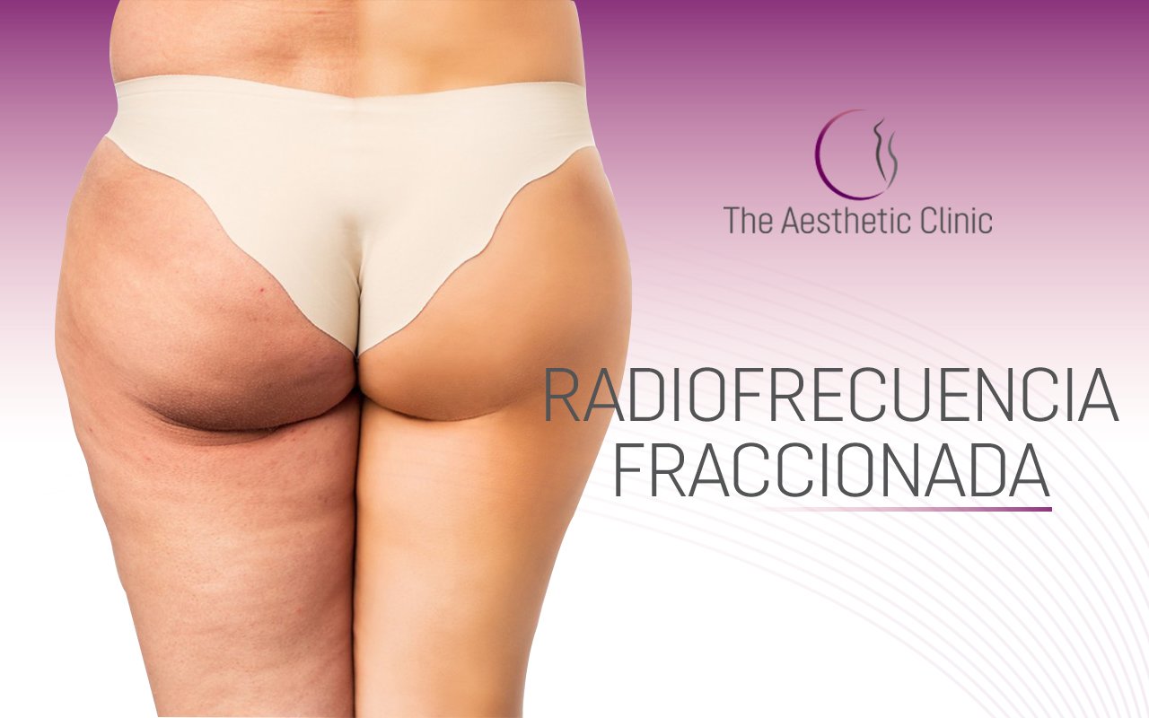 Fractionated radiofrequency with microneedles